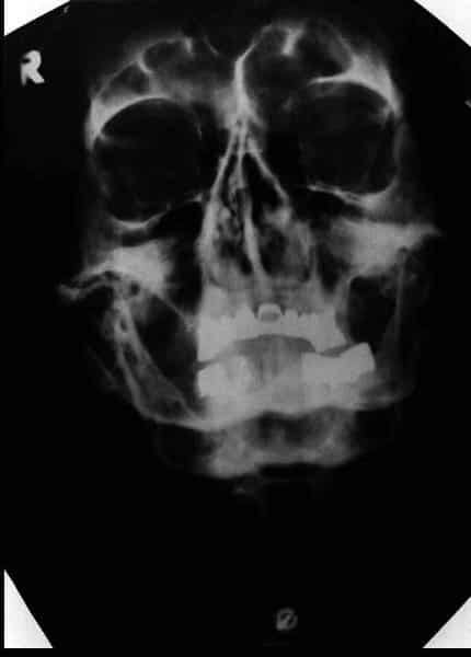 Adolf Hitler Skull X Ray