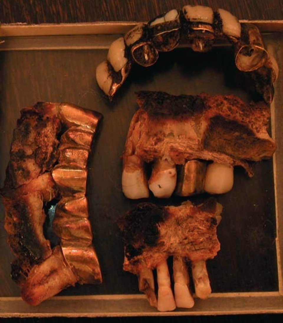 Hitler's teeth, as kept in the Russian Federal Archives in Moscow - Public Domain