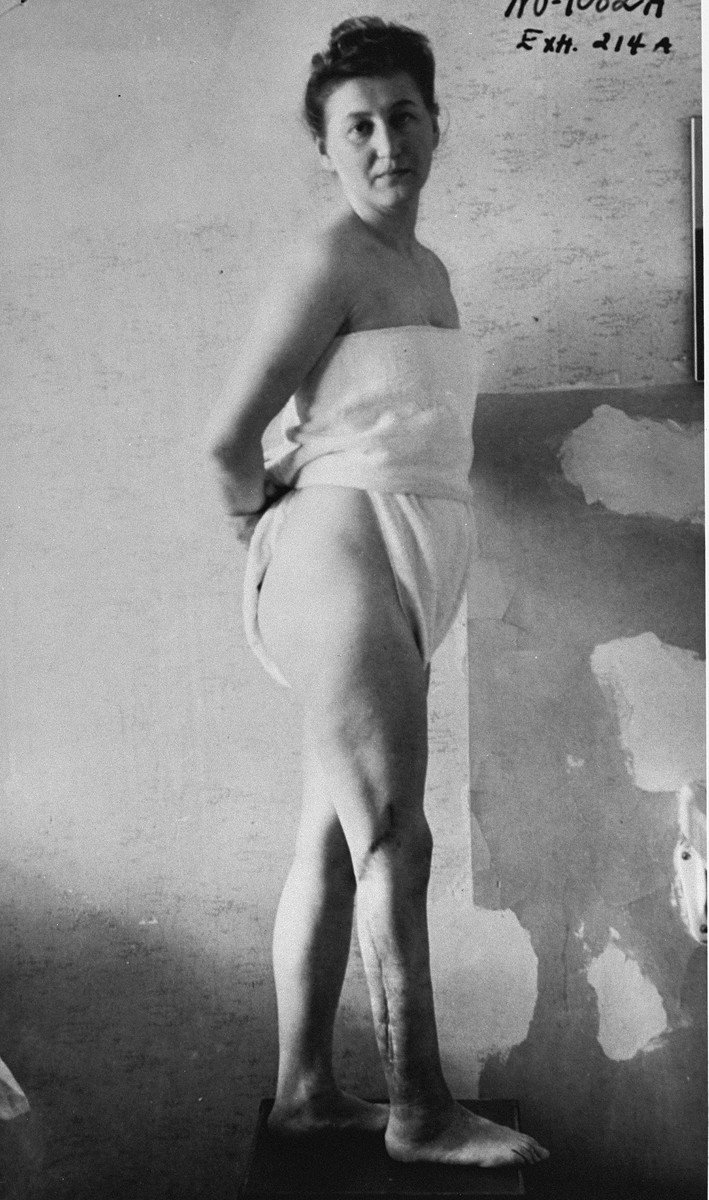Photograph of Ravensbrück concentration camp prisoner Jadwiga Dzido (1918-1985) revealing the scars to her leg caused by Nazi medical experiments (1947) - Public Domain